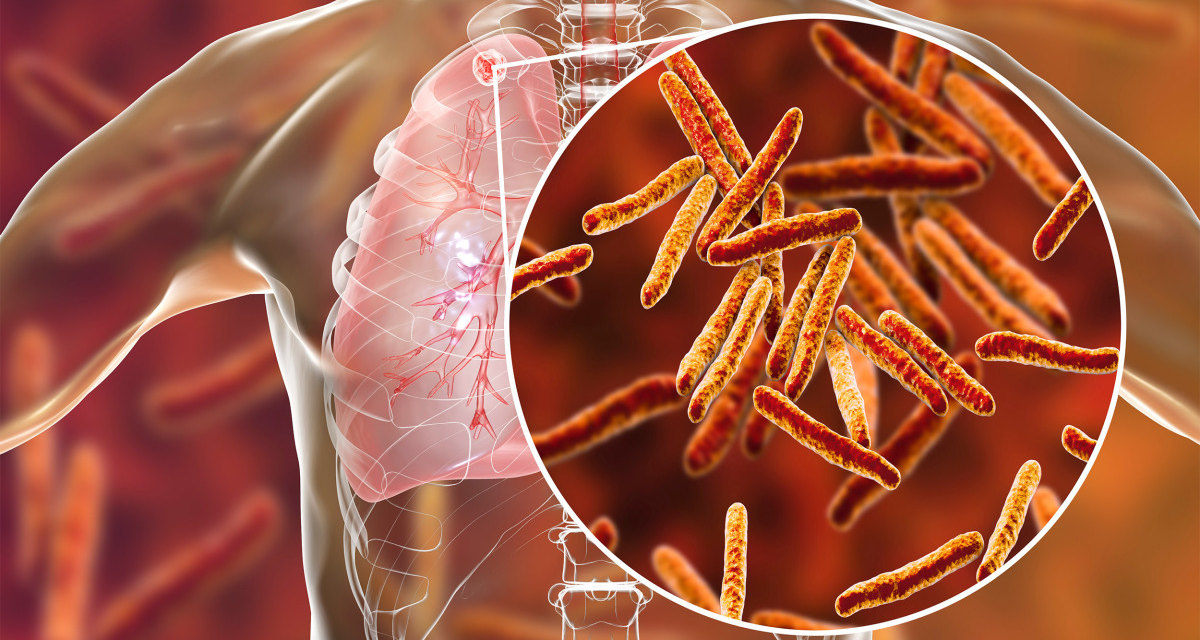 Пост сдал, пост принял: коронавирус может сменить эпидемия туберкулеза